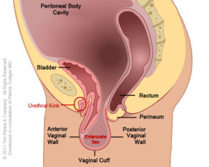 Prolapse after Childbirth: What can you do?