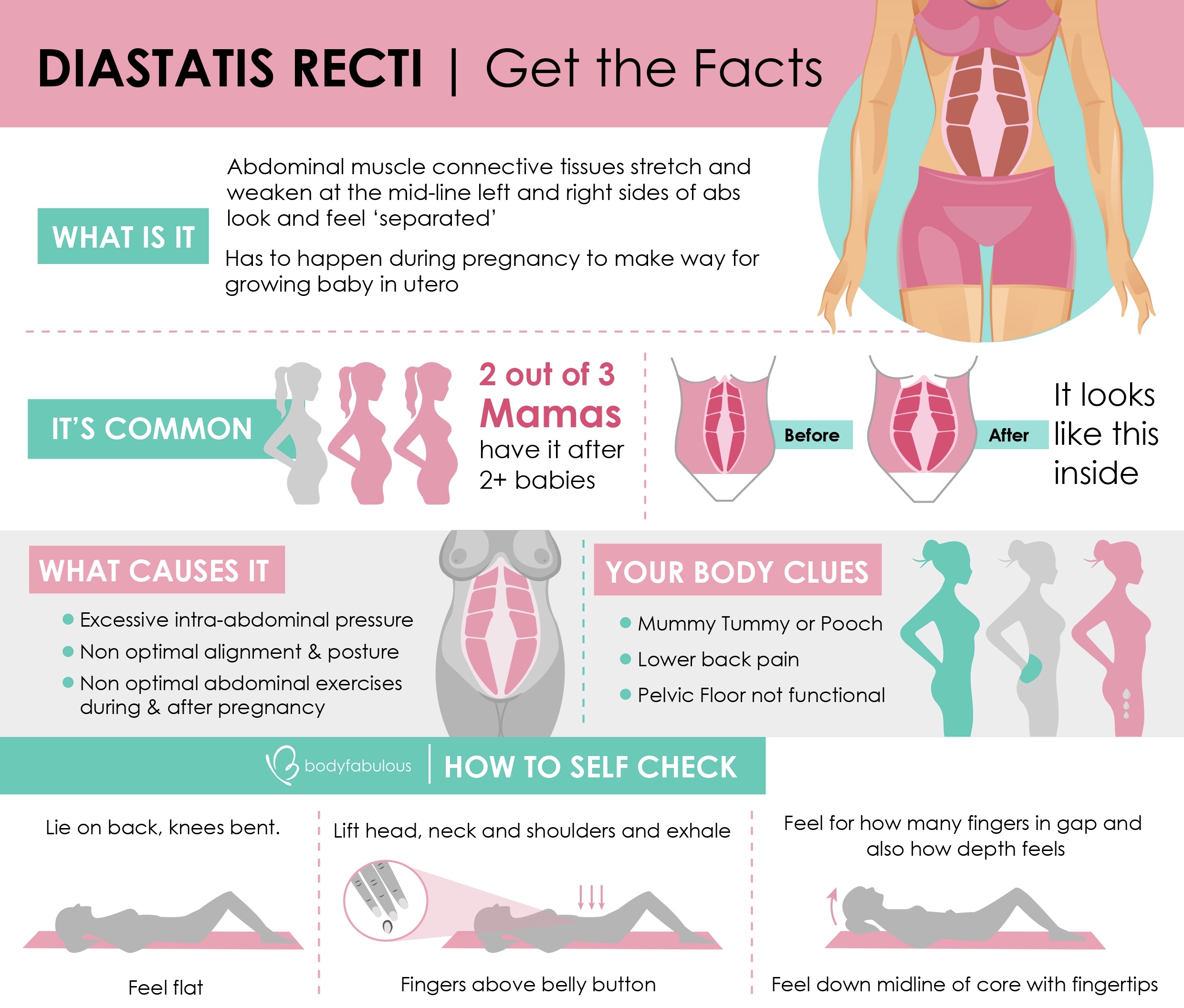 Get the facts on Abdominal Separation or Diastasis Recti | BodyFabulous ...