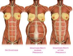 How to measure your Diastatis Recti / Abdominal Separation - BodyFabulous  Pregnancy Women's Fitness